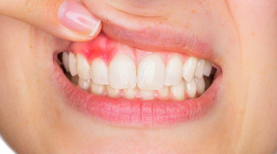 What Is Gum Disease (Periodontology)?