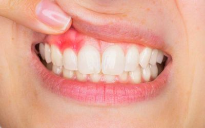 What Is Gum Disease (Periodontology)?