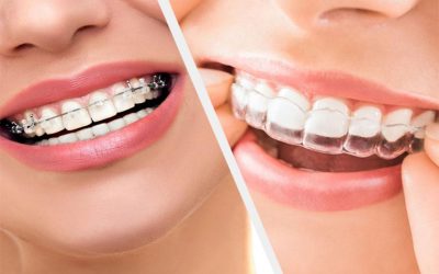 What is Orthodontic Treatment?