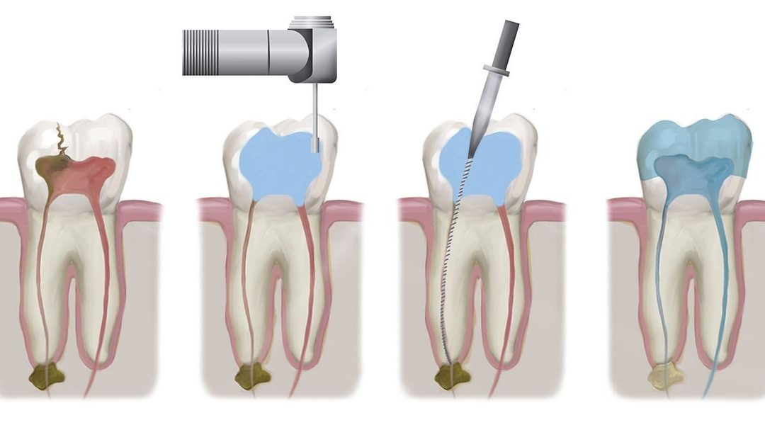 Why Root Canal Treatment is Done?