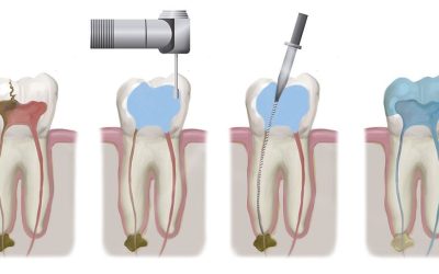 Why Root Canal Treatment is Done?