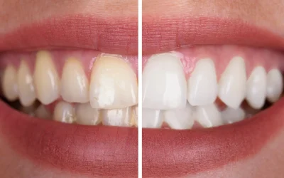 Zirconium Veneers on Front Teeth
